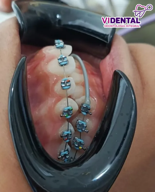 Imagen de Fluorización